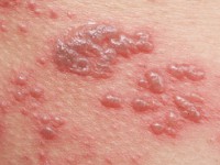 Nhân 01 trường hợp bệnh nhân zona thần kinh đến khám và điều trị