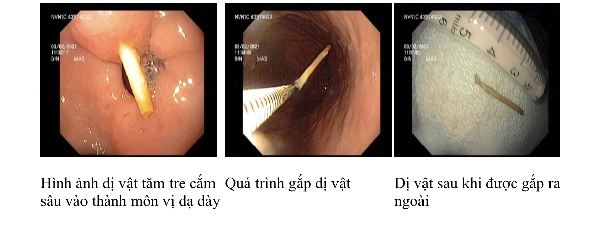 Cảnh báo: Dị vật đường tiêu hóa do nuốt phải tăm tre