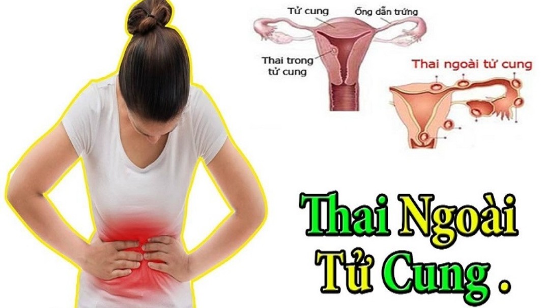 Tiếp nhận xử lý kịp thời trường hợp mang thai ngoài tử cung nguy hiểm đến tính mạng