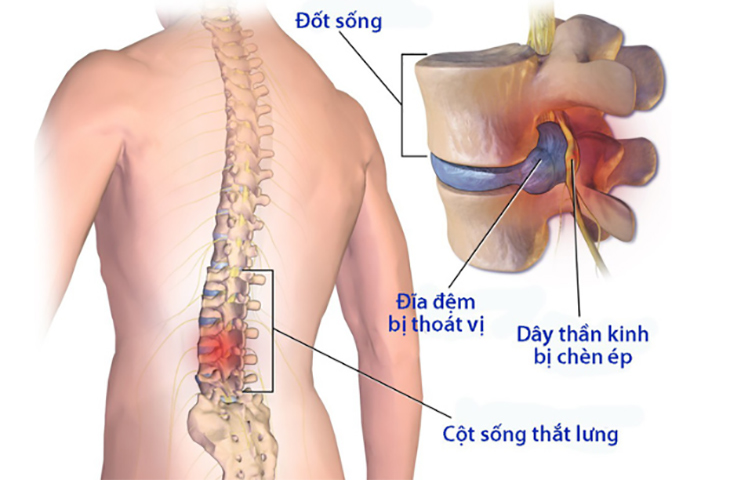 Chẩn đoán và điều trị bệnh lý cột sống tại bệnh viện Đa khoa tỉnh Cao Bằng.