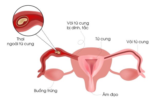 CẨN TRỌNG VỚI TÌNH TRẠNG MANG THAI NGOÀI TỬ CUNG.