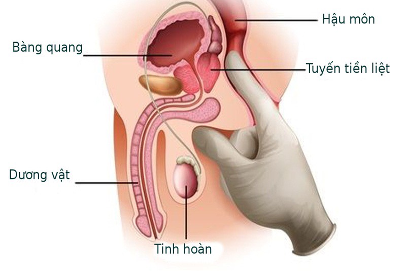 Cảnh báo những dấu hiệu vỡ hang vật ở nam giới.