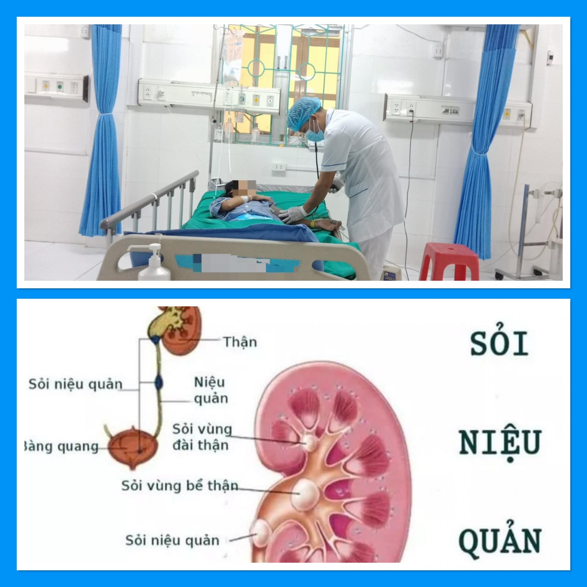 Cảnh báo bệnh nhân sốc nhiễm khuẩn, suy đa tạng do sỏi thận