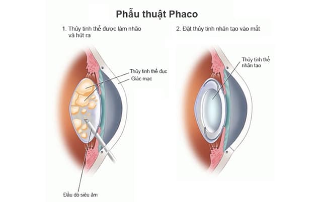 ảnh minh họa mổ phaco