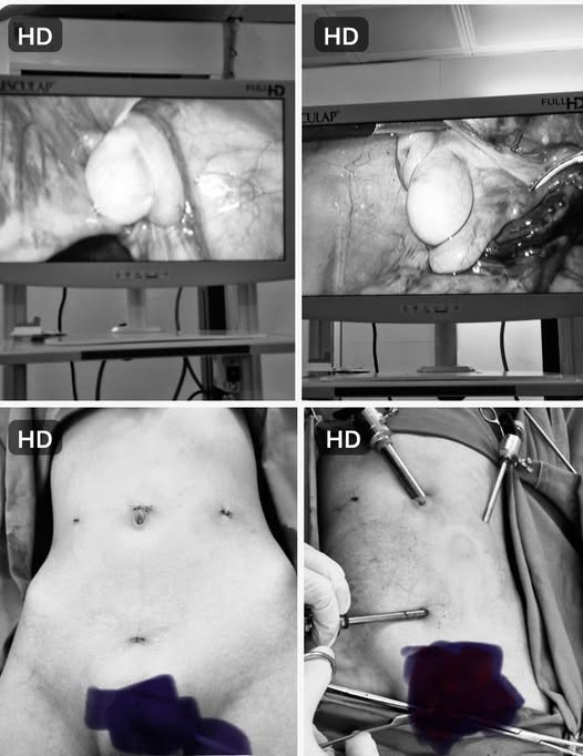 Phẫu thuật nội soi hạ tinh hoàn thành công cho bệnh nhi 11 tuổi