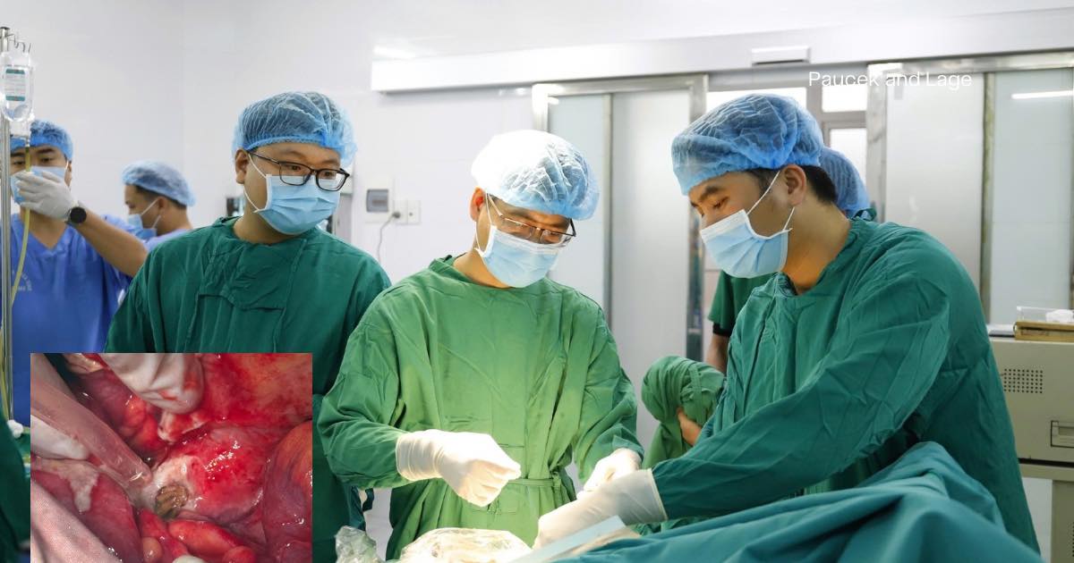 Sau nuốt hạt nhót, cụ bà cao tuổi phải phẫu thuật cấp cứu vì thủng trực tràng